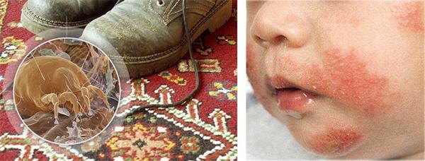 Наличие пылевых клещей в доме – это  серьезная угроза здоровью и самочувствию семьи